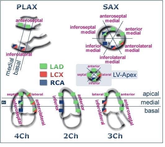 Koronare Versorgung der LV-Segmente: PLAX, SAX, 4Ch, 2Ch, 3Ch
